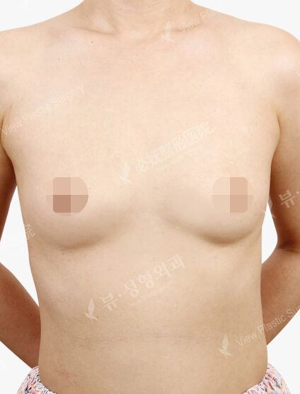 Breast Augmentation Tear Drop (9 Months) — Before