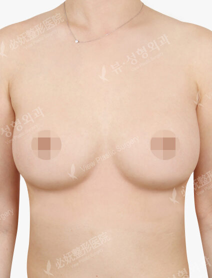 Breast Augmentation Tear Drop (9 Months) — After