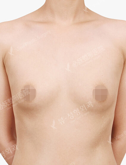 Breast Augmentation Tear Drop (15 Months) — Before