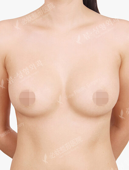 Breast Augmentation Tear Drop (15 Months) — After