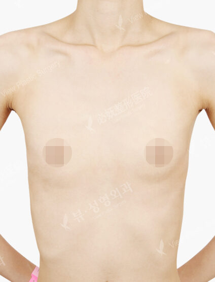 Breast Augmentation Tear Drop (14 Months) — Before
