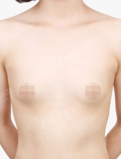 Breast Augmentation (5 Months) — Before