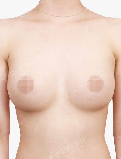 Breast Augmentation (5 Months) — After