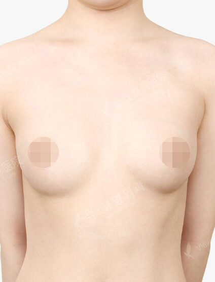 Breast Augmentation Tear Drop (4 Months) — Before