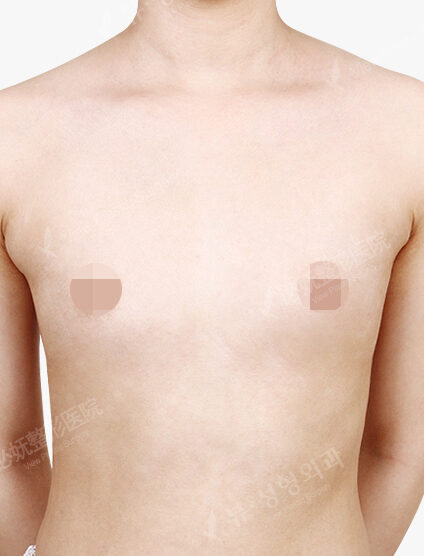 Breast Augmentation Tear Drop (5 Months) — Before