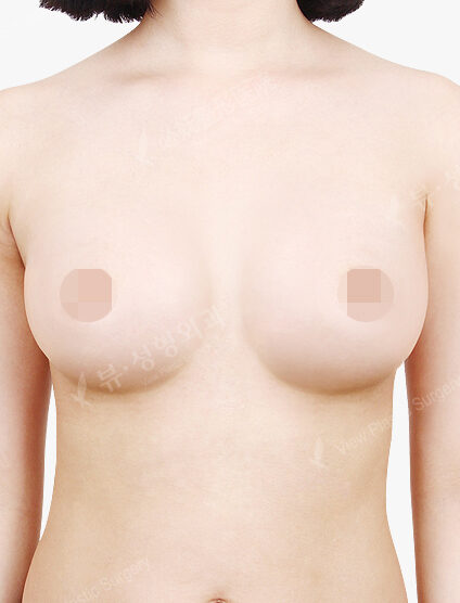 Breast Augmentation Tear Drop (5 Months) — After