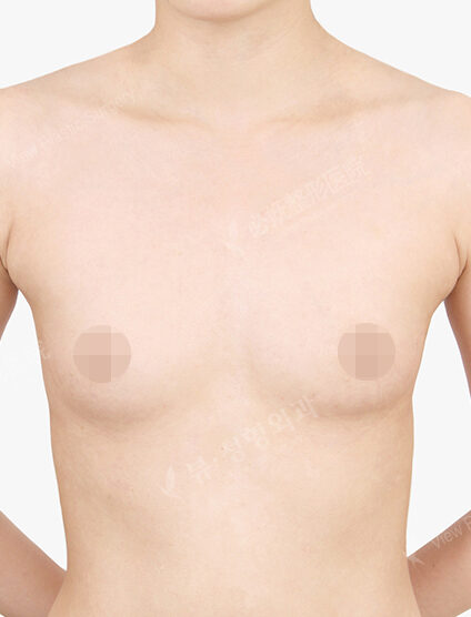 Breast Augmentation Tear Drop+Accessory Breast (23 Months) — Before