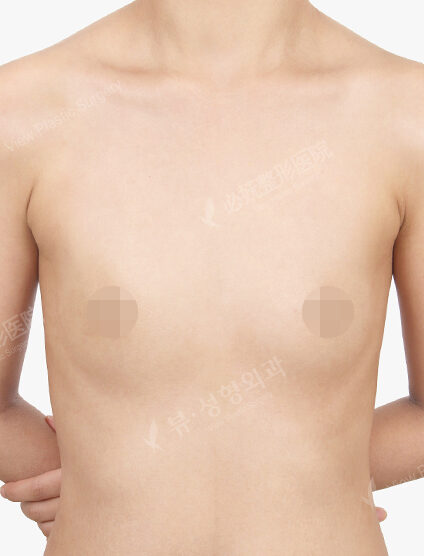 Breast Augmentation (3 Months) — Before