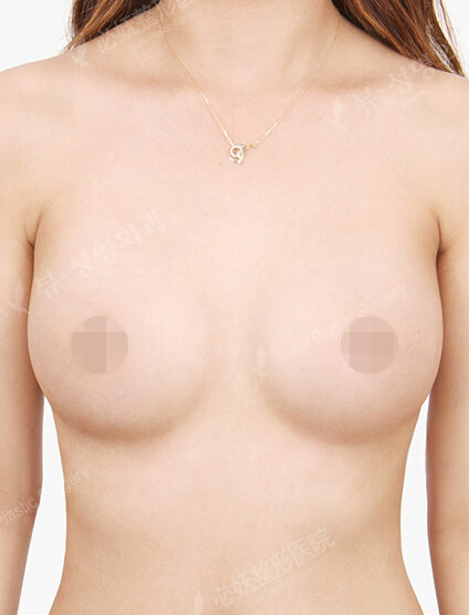 Breast Augmentation (3 Months) — After