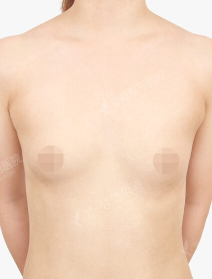 Breast Augmentation Tear Drop (5 Months) — Before