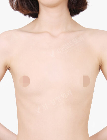 Breast Augmentation (12 Months) — Before