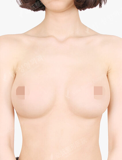 Breast Augmentation (12 Months) — After