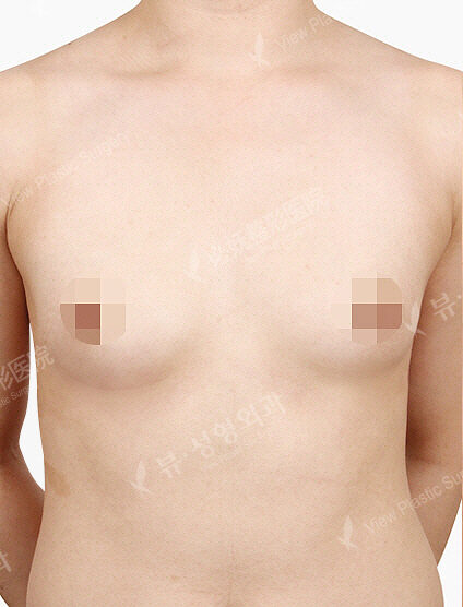 Breast Augmentation Tear Drop ( 5 Months) — Before