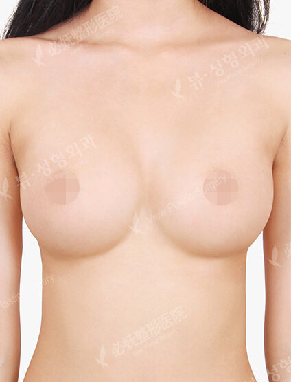 Breast Augmentation (5 Months) — After
