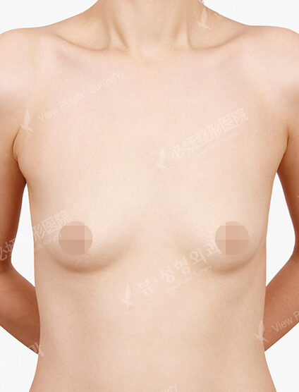 Breast Augmentation Tear Drop (4 Months) — Before