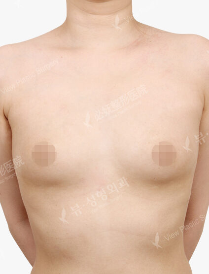 Breast Augmentation Tear Drop (3 Months) — Before