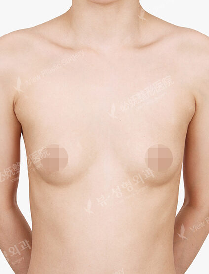Breast Augmentation Tear Drop+Accessory Breast (6 Months) — Before