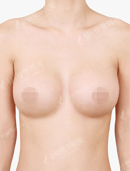 Breast Augmentation Tear Drop+Accessory Breast (6 Months) — After