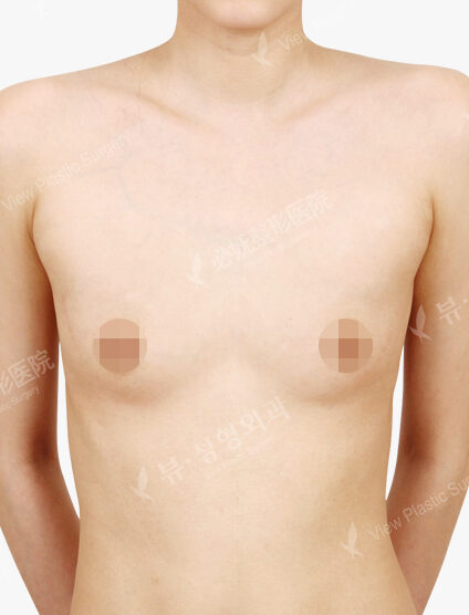 Breast Augmentation (4 Months) — Before