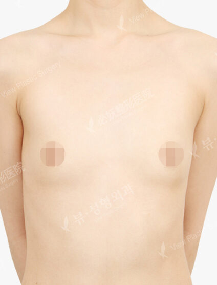Breast Augmentation Tear Drop (3 Months) — Before