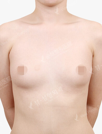 Breast Augmentation (5 Months) — Before