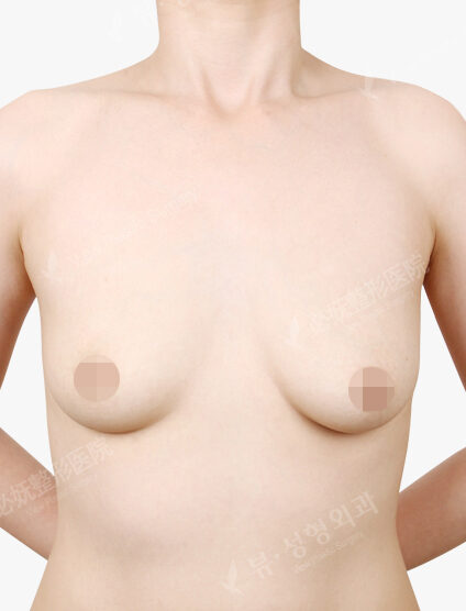 Tear Drop Breast Augmentation(4 Months) — Before
