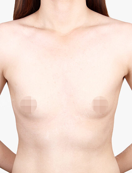 Breast Augmentation (3 Months) — Before