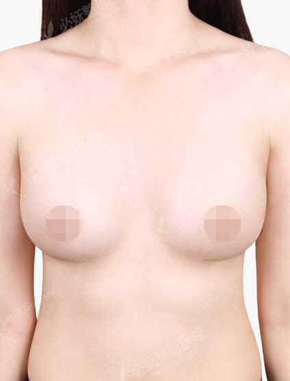 Breast Augmentation (3 Months) — After