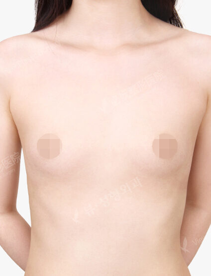 Breast Augmentation (5 Months) — Before
