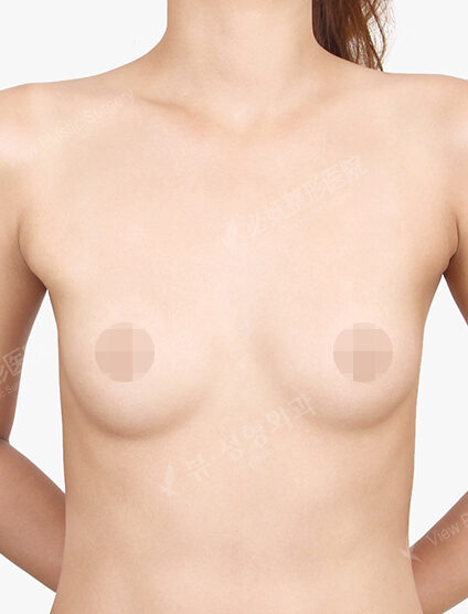 Breast Augmentation (5 Months) — Before