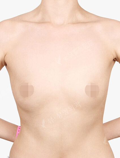 Breast Augmentation (13 Months) — Before