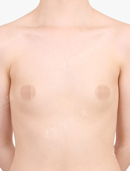 Breast Augmentation (6 Months) — Before