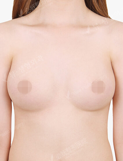 Breast Augmentation (6 Months) — After