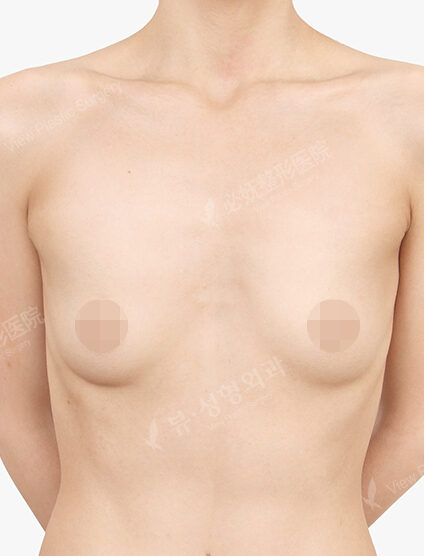 Breast Augmentation (8 Months) — Before