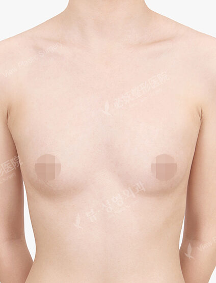 Breast Augmentation (9 Months) — Before