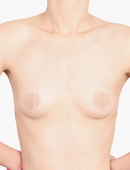 Breast Augmentation (8 Months) — Before