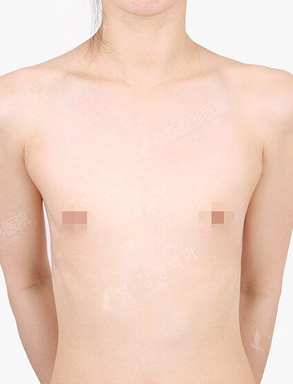 Breast Augmentation (8 Months) — Before