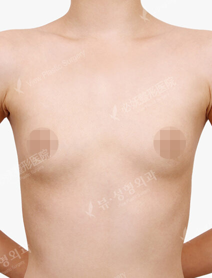 Breast Augmentation ( 5 Months) — Before
