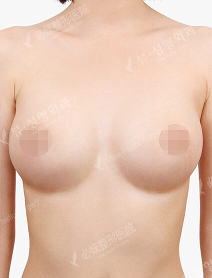 Breast Augmentation ( 5 Months) — After