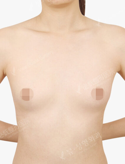 Breast Augmentation(10 Months) — Before