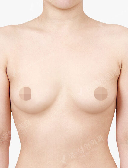 Breast Augmentation(5 Months) — Before