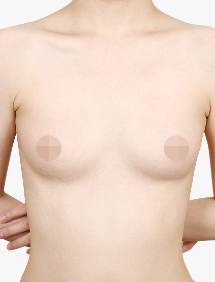 Breast Augmentation(4 Months) — Before