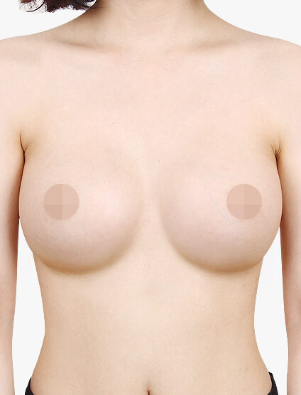 Breast Augmentation(4 Months) — After