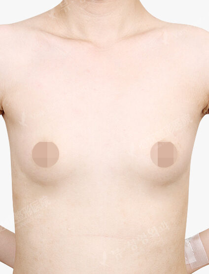 Breast Augmentation (12 Months) — Before