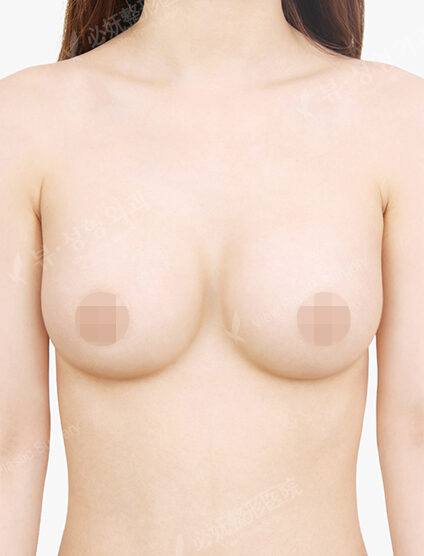 Breast Augmentation (7 Months) — After