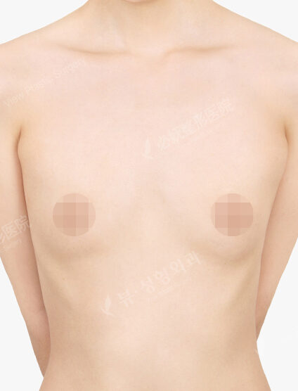Breast Augmentation (13 Months) — Before