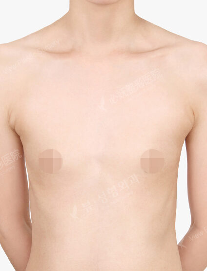 Breast Augmentation (6 Months) — Before