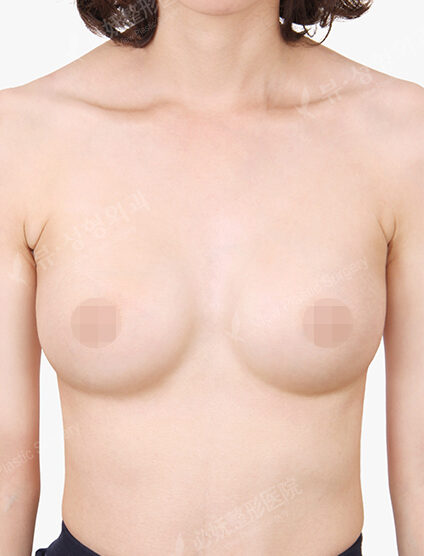 Breast Augmentation (6 Months) — After