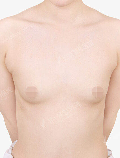 Breast Augmentation (3 Months) — Before