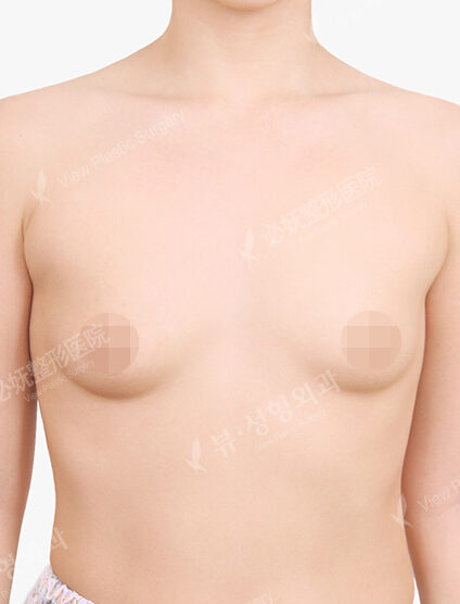 Breast Augmentation (6 Months) — Before